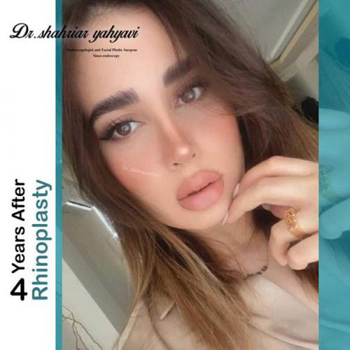 جراحی-بینی-652
