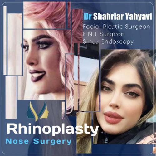 جراحی-بینی-654