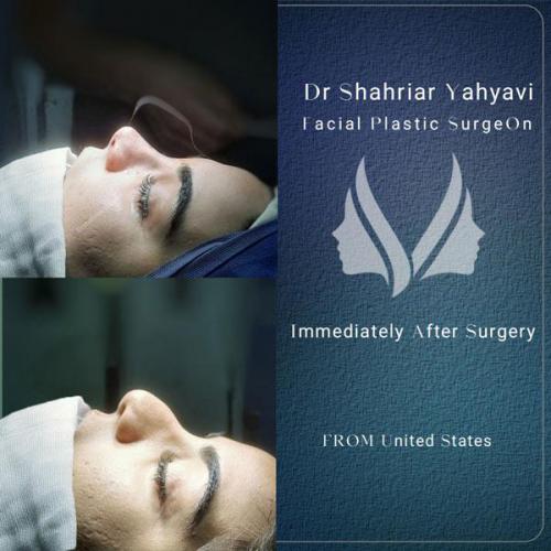 جراحی-بینی-655