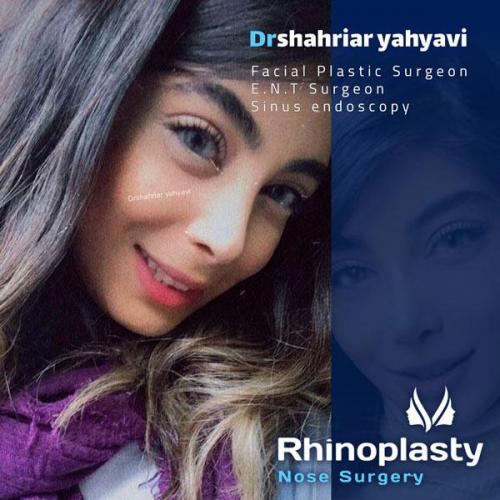 جراحی-بینی-656