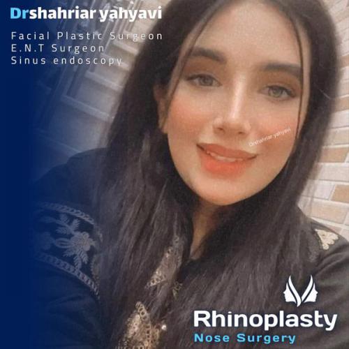جراحی-بینی-658
