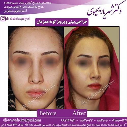 جراحی-بینی-66
