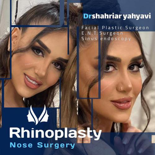 جراحی-بینی-661