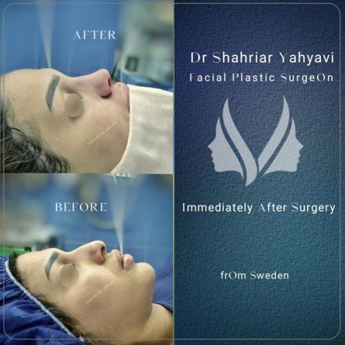 جراحی-بینی-666