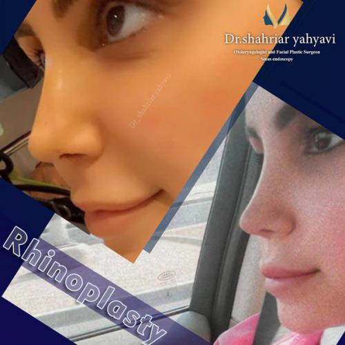 جراحی-بینی-674