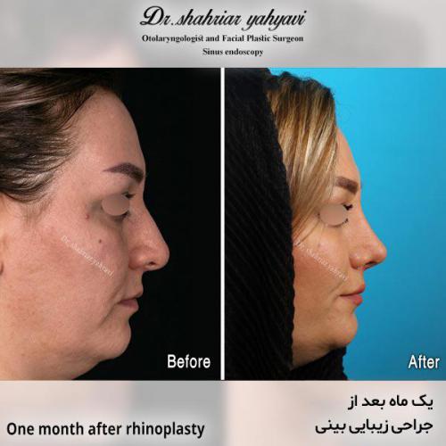 جراحی-بینی-675