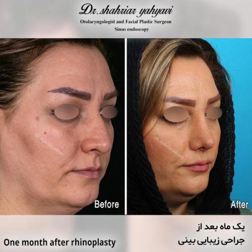 جراحی-بینی-676