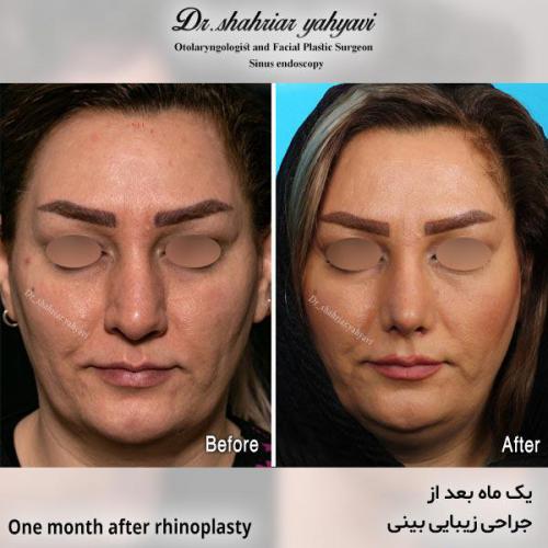 جراحی-بینی-677