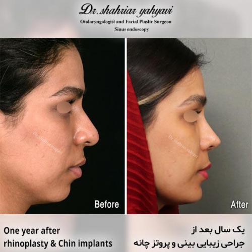 جراحی-بینی-678