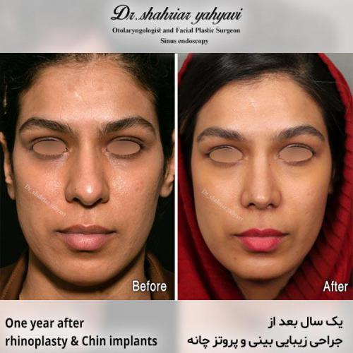 جراحی-بینی-679
