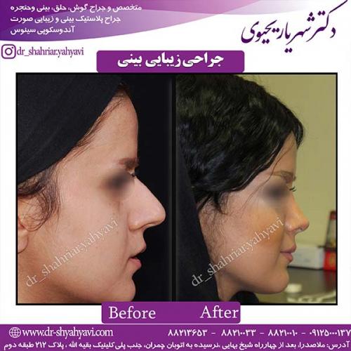جراحی-بینی-68