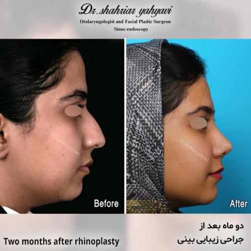 جراحی-بینی-680