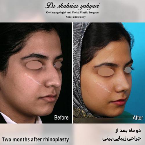 جراحی-بینی-681