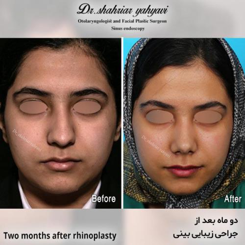 جراحی-بینی-682