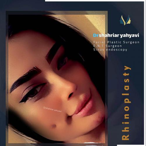 جراحی-بینی-683