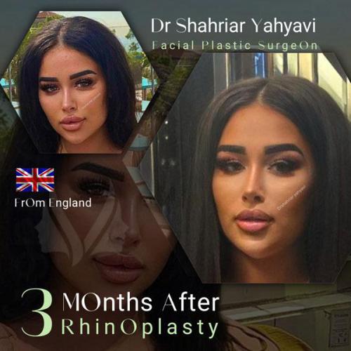 جراحی-بینی-684