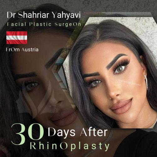 جراحی-بینی-685