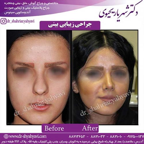 جراحی-بینی-69