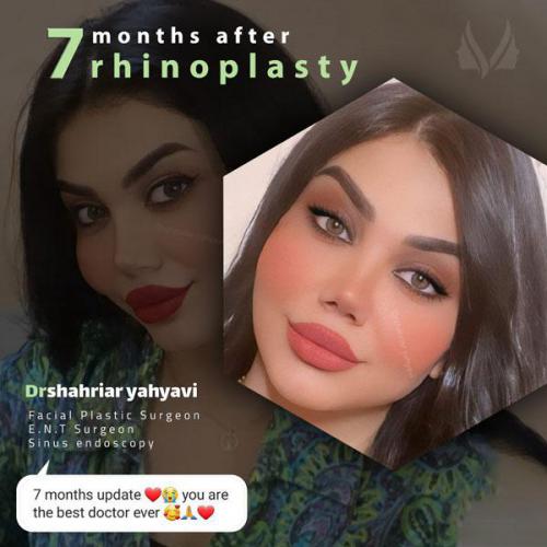 جراحی-بینی-692