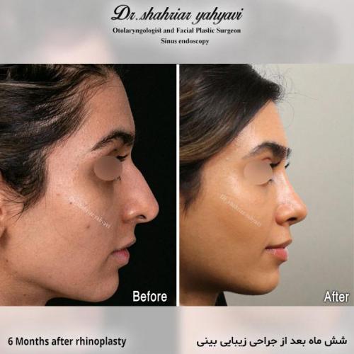 جراحی-بینی-693