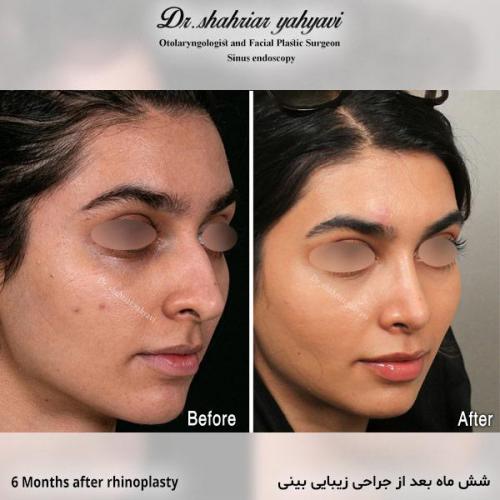 جراحی-بینی-694