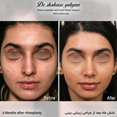جراحی-بینی-695
