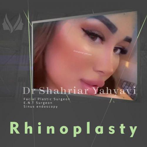 جراحی-بینی-696