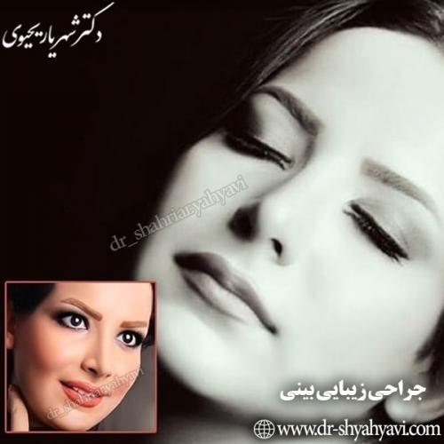 جراحی-بینی-70