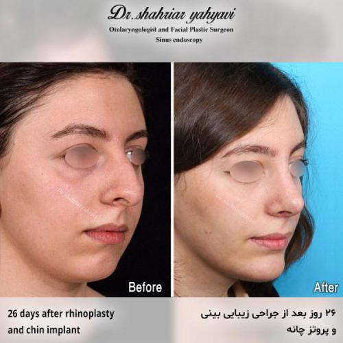 جراحی-بینی-700