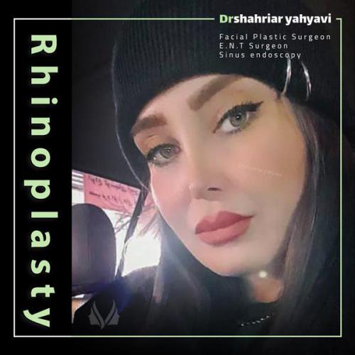 جراحی-بینی-705