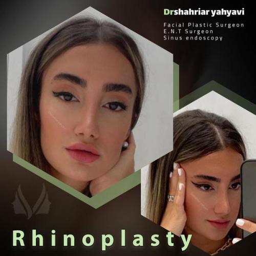 جراحی-بینی-706