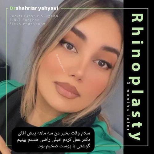 جراحی-بینی-709