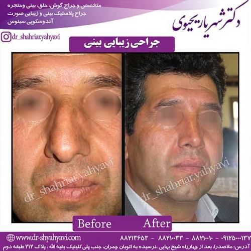 جراحی-بینی-71
