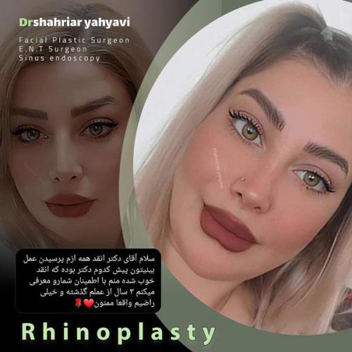 جراحی-بینی-710