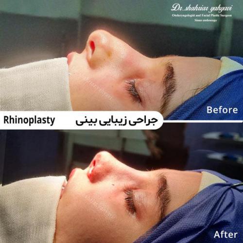 جراحی-بینی-711