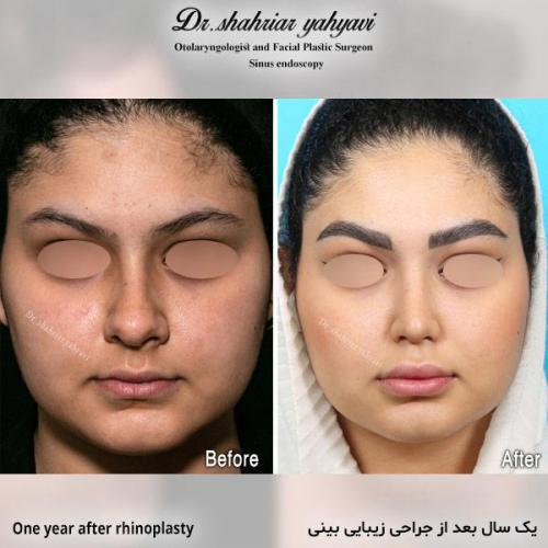 جراحی-بینی-713