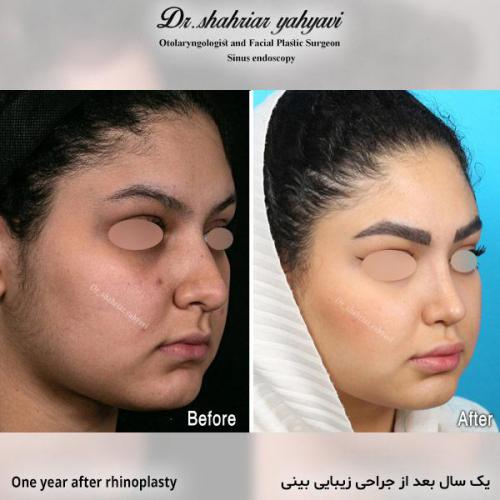 جراحی-بینی-714