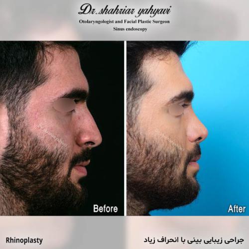 جراحی-بینی-718