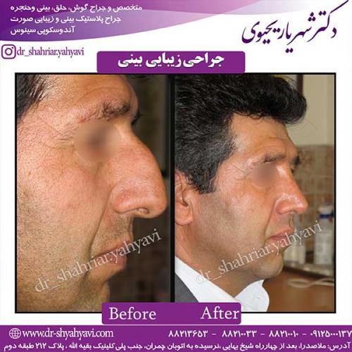 جراحی-بینی-72