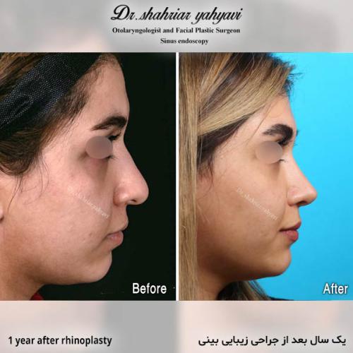 جراحی-بینی-722
