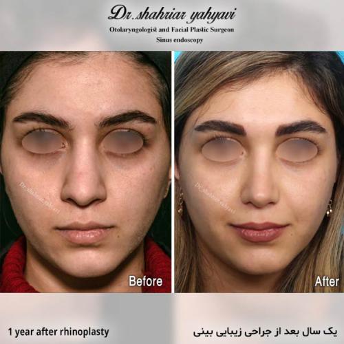جراحی-بینی-723