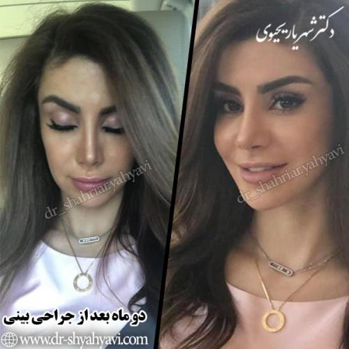 جراحی-بینی-73