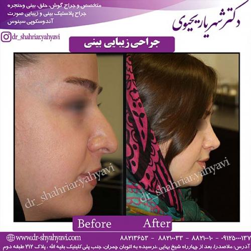 جراحی-بینی-77
