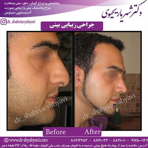 جراحی-بینی-80