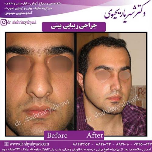جراحی-بینی-81