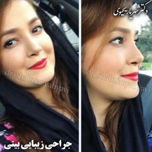 جراحی-بینی-82