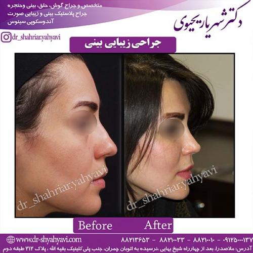 جراحی-بینی-83
