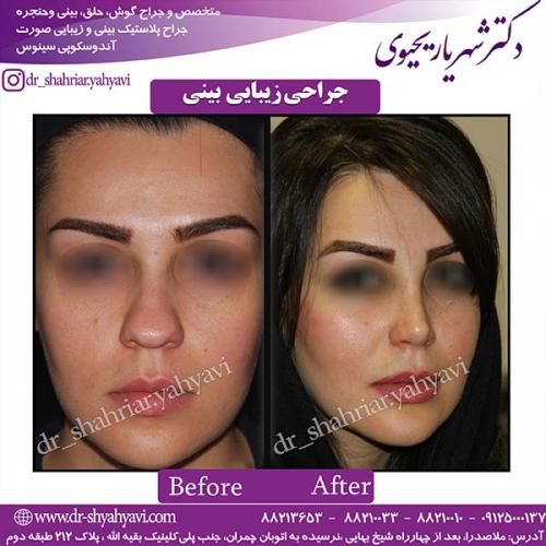 جراحی-بینی-84