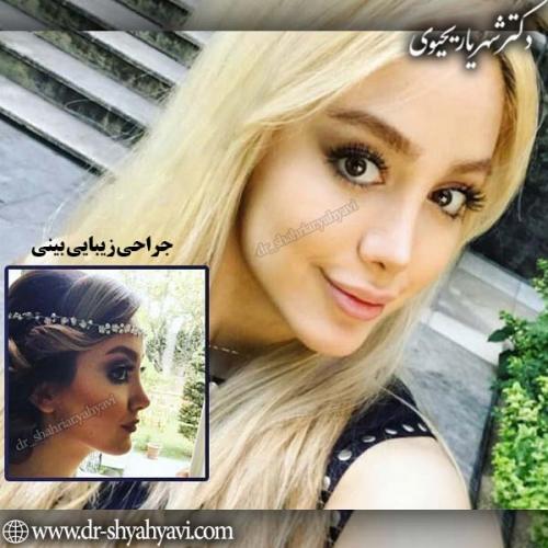 جراحی-بینی-85