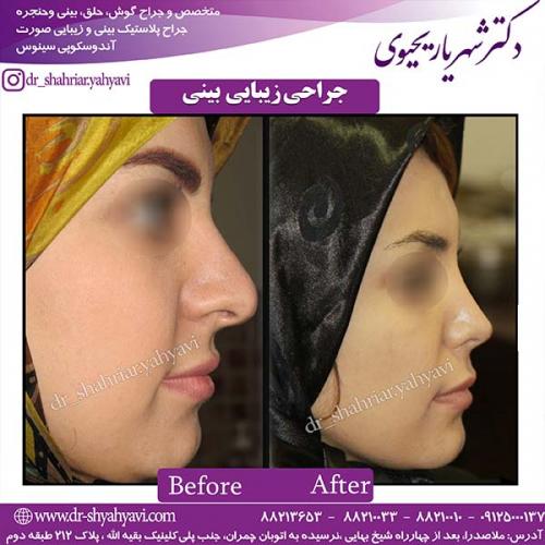 جراحی-بینی-86